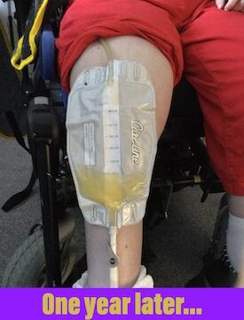 suprapubic catheter leg bag - one year later