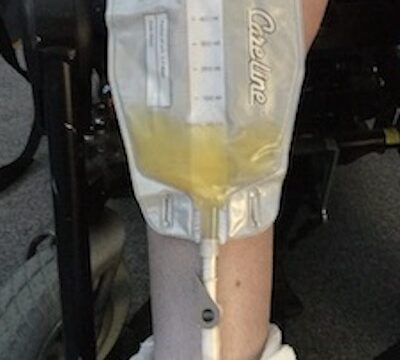 Emma's catheter bag