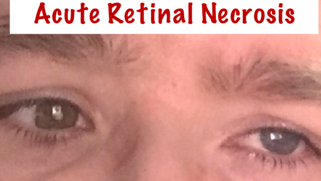 Acute Retinal Necrosis Red blob Drawn-representation-of-the-flash-semi-circle-disco-ball-e1602441093872.jpg Road-at-night-time-e1602440427545.jpg Trees-outdoors-e1602440171565.jpg Book-text-e1602439719772.jpg written in in red with an image of Emma's eyes underneath